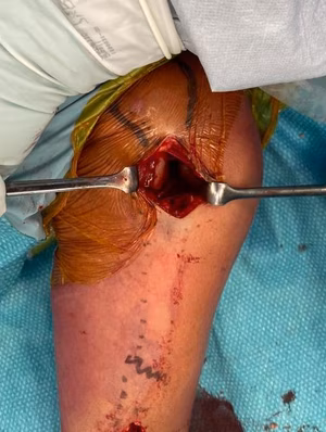 MIPO incisions 2
