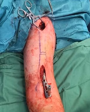 MIPO plate insertion