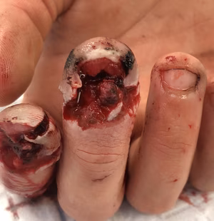 Complete nail bed injury