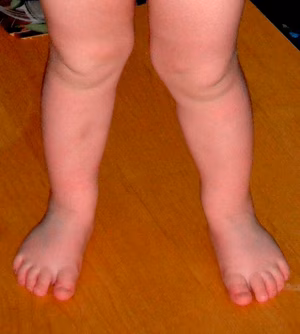 3 year old knock knees