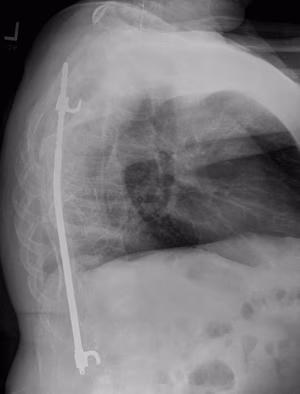 OI Scoliosis