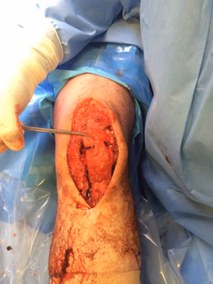 Chronic patella tendon rupture Hamstring Recon