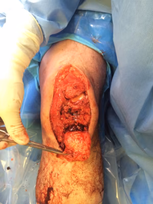 Chronic patella tendon rupture Hamstring Recon