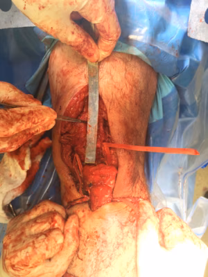 Chronic patella tendon rupture Hamstring Recon