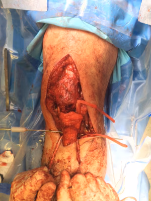 Chronic patella tendon rupture Hamstring Recon