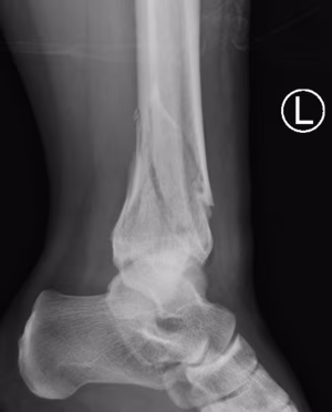 Distal tibia plate 2