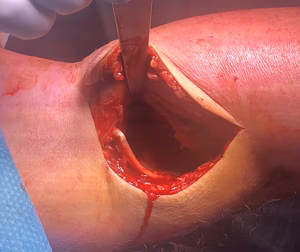 Posteromedial approach knee 2