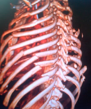 Rib fractures Flail Chest