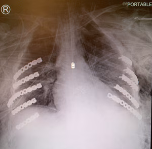 Rib Fracture Plates