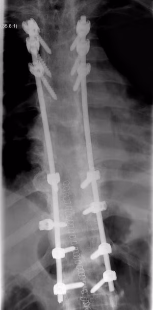 Ankylosing Spondylitis Thoracic Fracture Stabilisation AP
