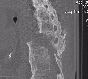 Ankylosing Spondylitis Thoracic Fracture CT