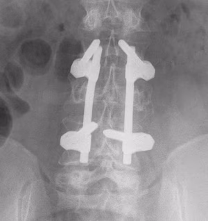 Burst Fracture Posterior stabilisation