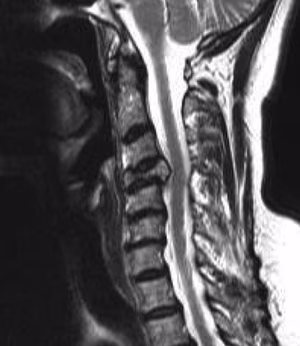 Cervical Metastasis MRI