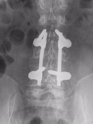 Crush Fracture Fusion 2