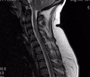 Cervical Epidural Abscess T1 MRI