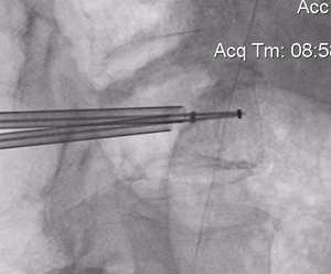 Kyphoplasty Insertion Lateral