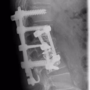 Lumbar Burst Fracture0003