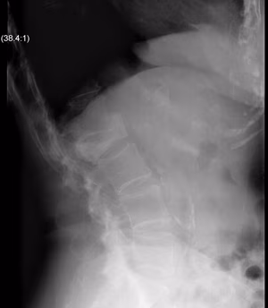Lumbar Metastasis Xray