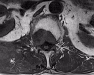Metastatic Tumour L1 MRI Axial