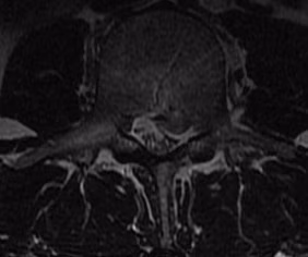 Sequestered Disc MRI 3