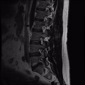 Herniated disc lateral Recess S1 nerve root compression