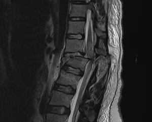 T12 L1 Soft Tissue Chance MRI