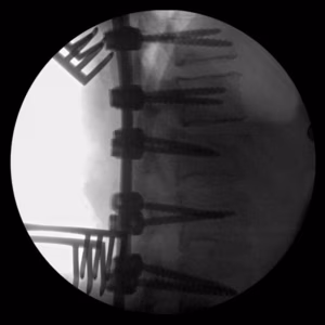 T12 L1 Soft Tissue Chance OT