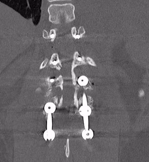 T12 L1 Soft Tissue Chance Posterior Decompression