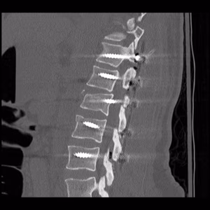 T12 L1 Soft Tissue Chance Posterior Stabilisation