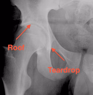 Acetabulum Roof and Teardrop
