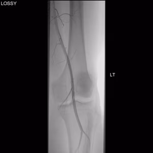 Angiogram Normal 1