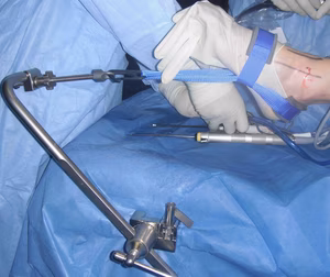 Ankle Arthroscopy Traction