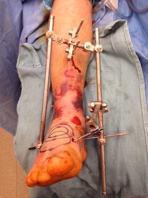 Ankle Ext Fix 3