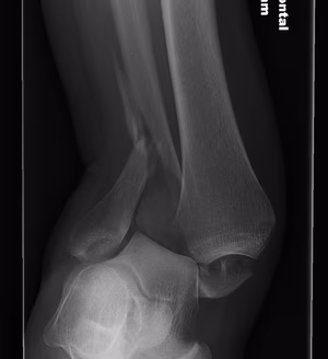 Ankle Fracture Pronation External Rotation