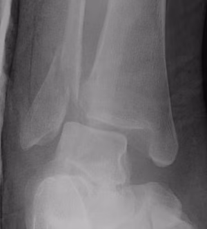 Ankle Fracture Weber B + Deltoid Ligament 