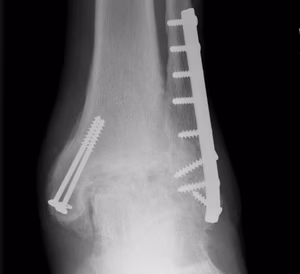 Ankle OA Post ORIF
