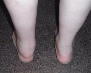 Ankle Synovitis