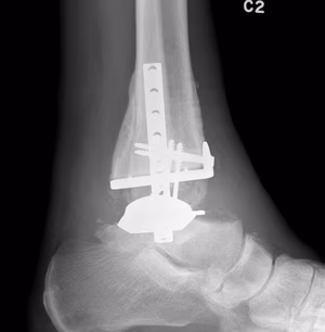 Ankle Arthroplasty post ORIF lateral