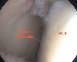 Ankle Scope Medial Gutter