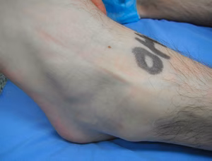 Ankle Superficial Peroneal Nerve