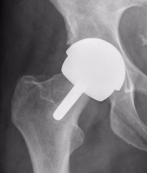 BHR Femoral Neck Notching 2