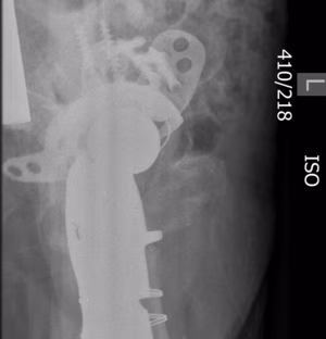 Bipolar Acetabular Destruction Revision 2