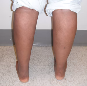 Calf Wasting Left Leg