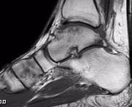 Ankle T1 MRI