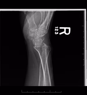 Dislocated DRUJ
