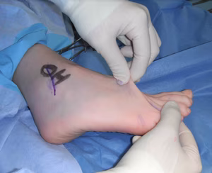 Ehler Danlos Fragile Skin