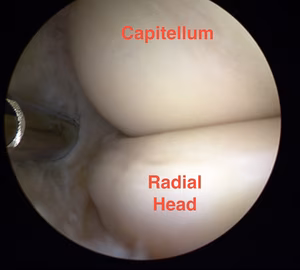 Elbow Arthroscopy Anterolateral