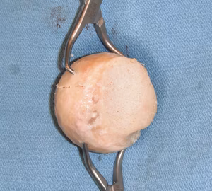 Femoral Head Allograft 2