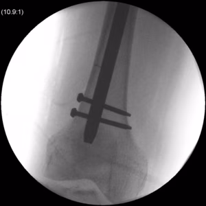 Femoral Nail Distal Locking0002