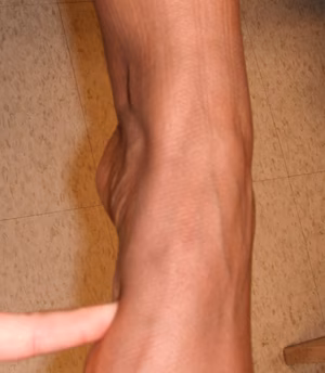 Foot Exam Tibialis Posterior